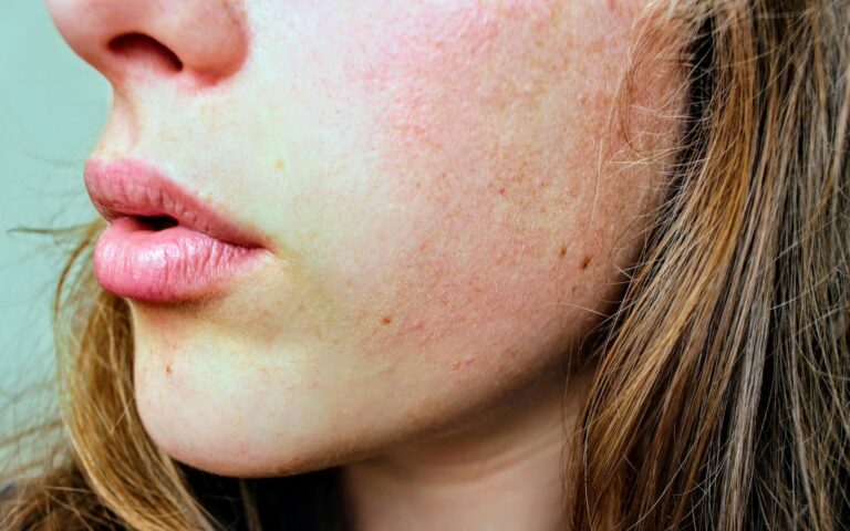 How to Deal with Dry, Flaky Skin in Winter